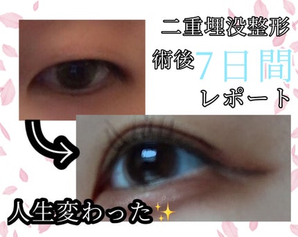 二重整形/その他を使ったクチコミ(1枚目)