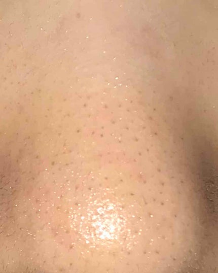 極潤ヒアルロン乳液/肌ラボ/乳液を使ったクチコミ(2枚目)