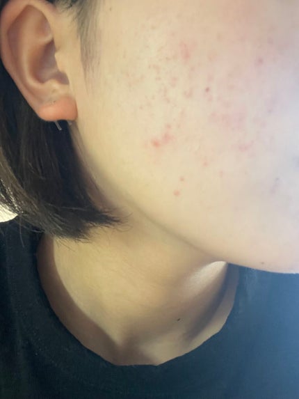 ri on LIPS 「生理周期が安定しているおかげで毎回のように生理が被って肌荒れし..」(1枚目)