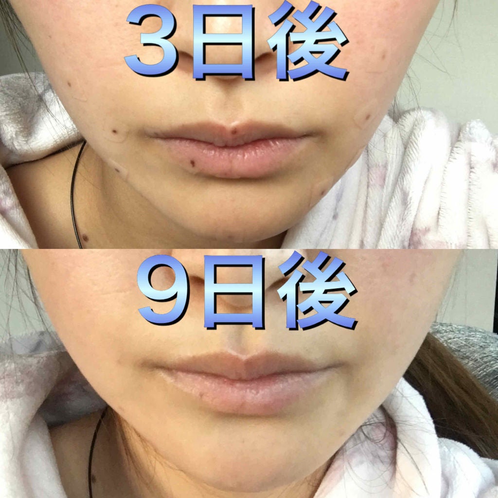 みす on LIPS 「私はほくろが出来やすく、ここ何年かでほくろが増えてきたのでピコ..」(3枚目)