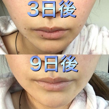 みす on LIPS 「私はほくろが出来やすく、ここ何年かでほくろが増えてきたのでピコ..」（3枚目）