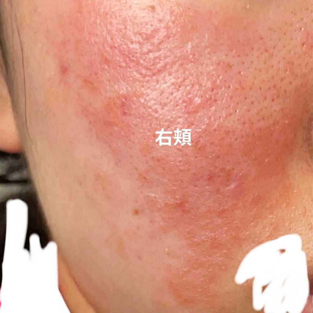 あいか on LIPS 「5日目です。顔の赤みが酷くなっています..」(4枚目)