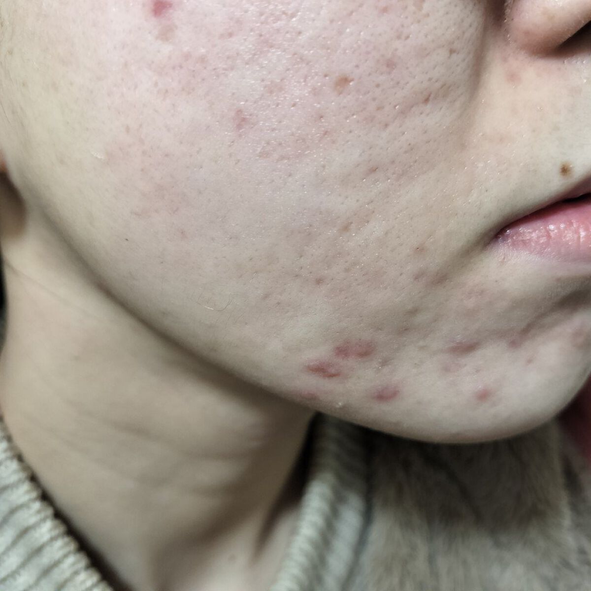 テラ・コートリル 軟膏(医薬品)/ジョンソン・エンド・ジョンソン/その他を使ったクチコミ（1枚目）