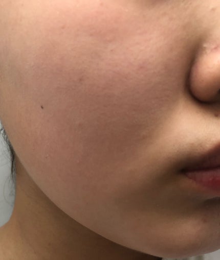 라임 on LIPS 「こんにちは❕2枚目からの写真を見るとおりニキビ、ニキビ跡、毛穴..」(3枚目)