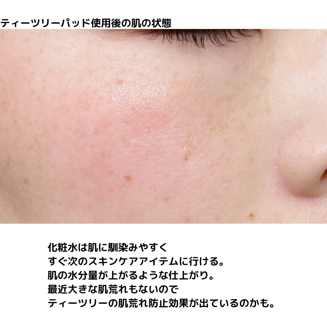 ティーツリー トラブルパッド/MEDIHEAL/トナーパッドを使ったクチコミ(6枚目)