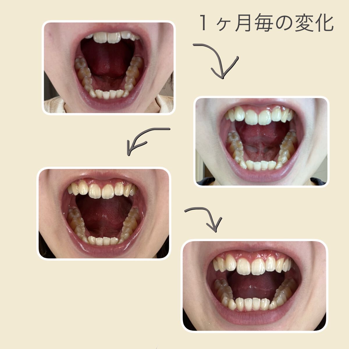 cokko on LIPS 「SH矯正を始めて4ヶ月が経過しました!今回は上 0.8mm下 ..」(3枚目)