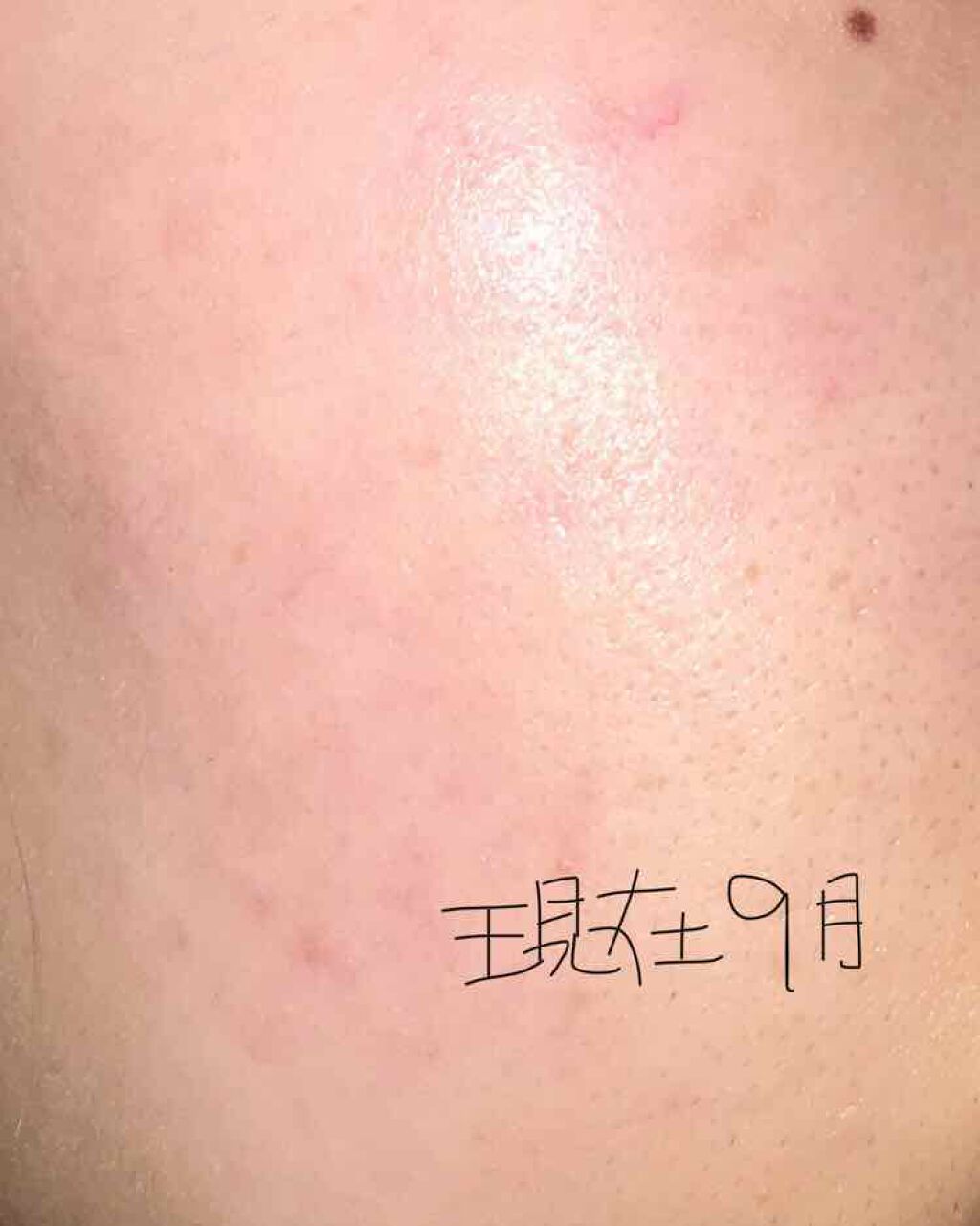 アクアチムローション、アクアチムクリーム(医薬品)/大塚製薬/その他を使ったクチコミ（3枚目）