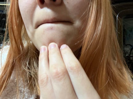 ニキビ治療薬クリーム (医薬品) 肌色/クレアラシル/その他を使ったクチコミ(2枚目)