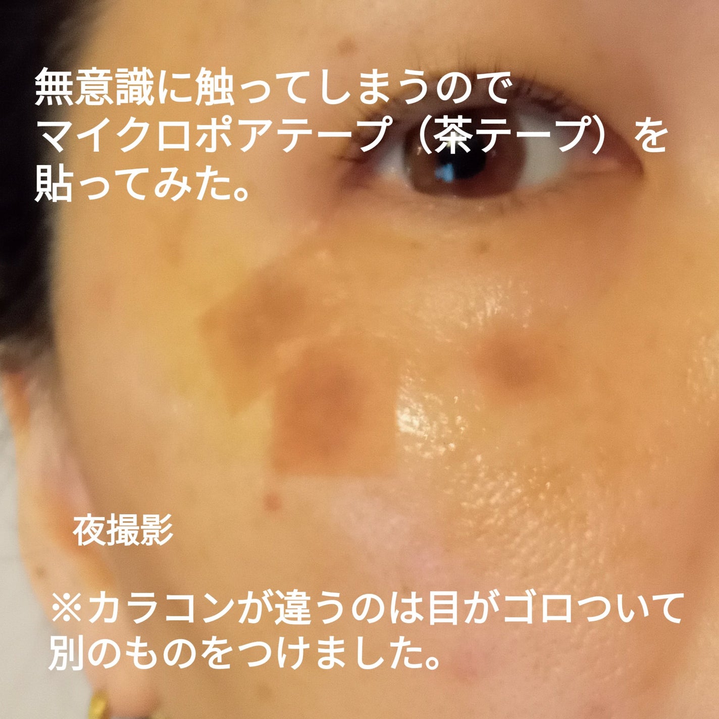 ビヨンセ奥二重向上委員長🥸LIPSパートナー🥳 on LIPS 「シミ取りレーザーの経過です。顔を洗う時やタオルでポンポン優しく..」(2枚目)