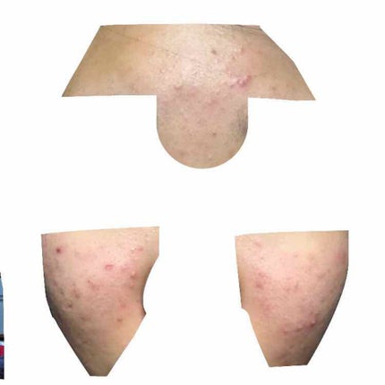 ニキビ治療薬(医薬品)/メンソレータム アクネス/その他を使ったクチコミ(3枚目)