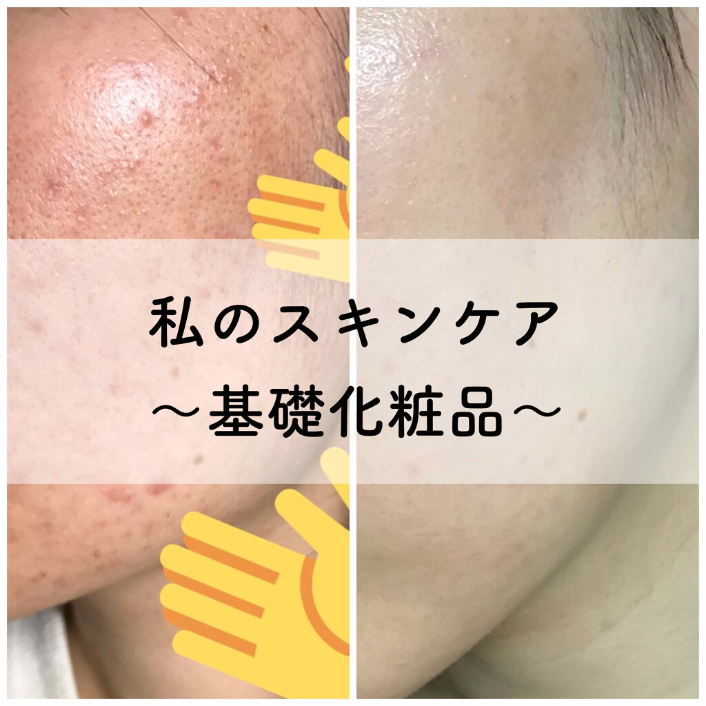 AC フェイスローション/NOV/化粧水を使ったクチコミ（1枚目）