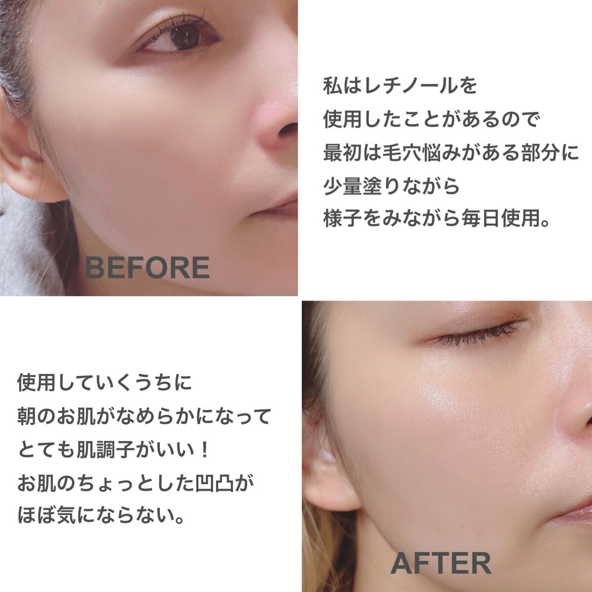 シカレチA エッセンス0.1/VT/美容液を使ったクチコミ（3枚目）