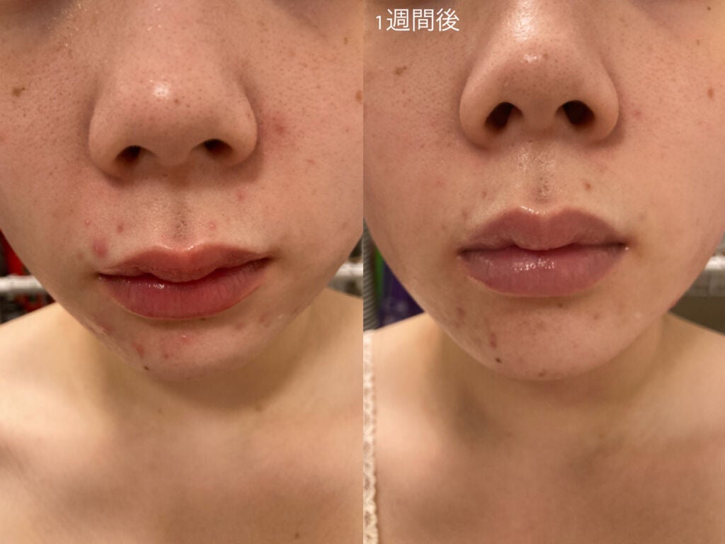 ピュアビタミン C21.5 アドバンスドセラム/By Wishtrend/美容液を使ったクチコミ(4枚目)