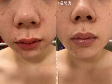 ピュアビタミン C21.5 アドバンスドセラム/By Wishtrend/美容液を使ったクチコミ(4枚目)