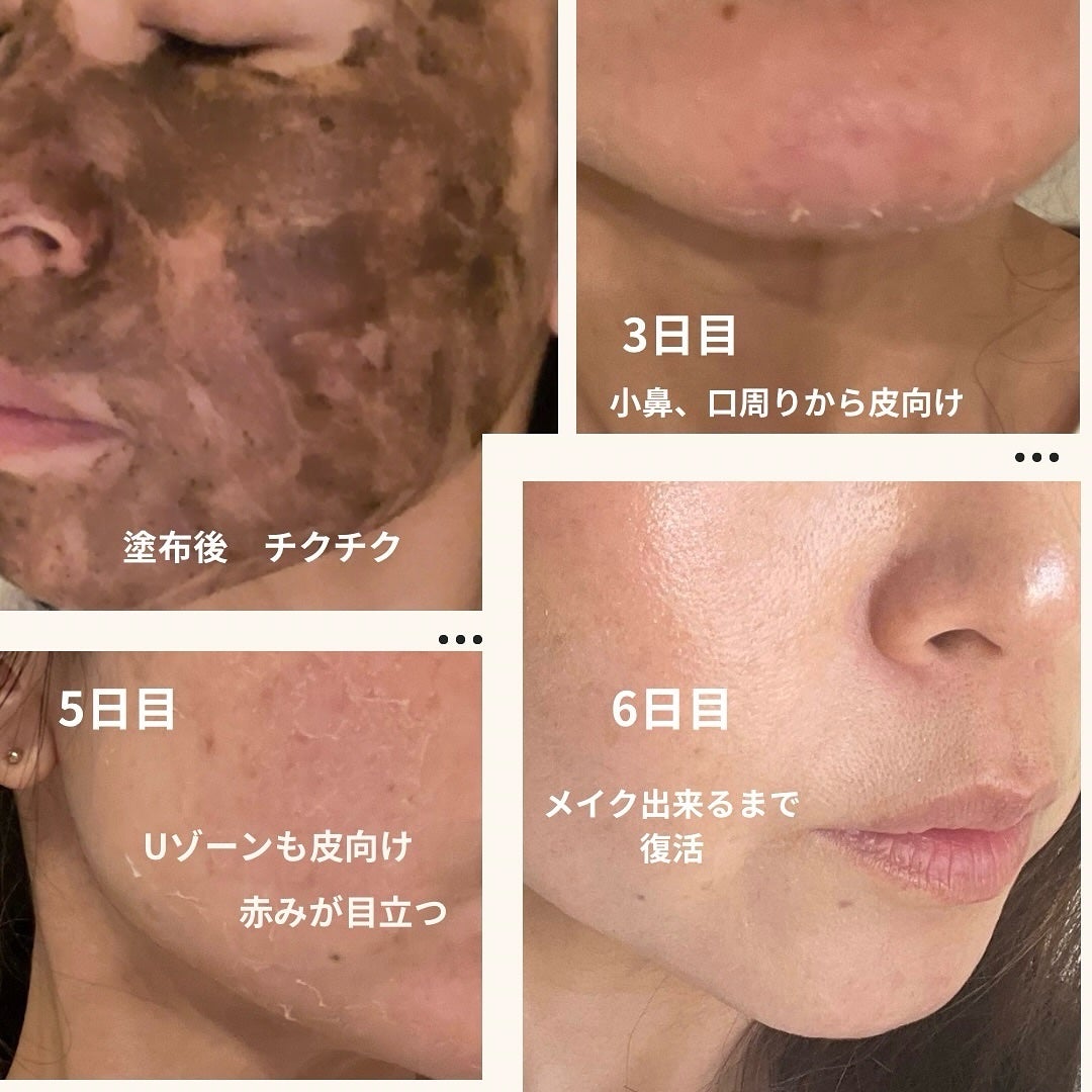 ダーマスキンピーリング/BQCELL/その他キットセットを使ったクチコミ(2枚目)