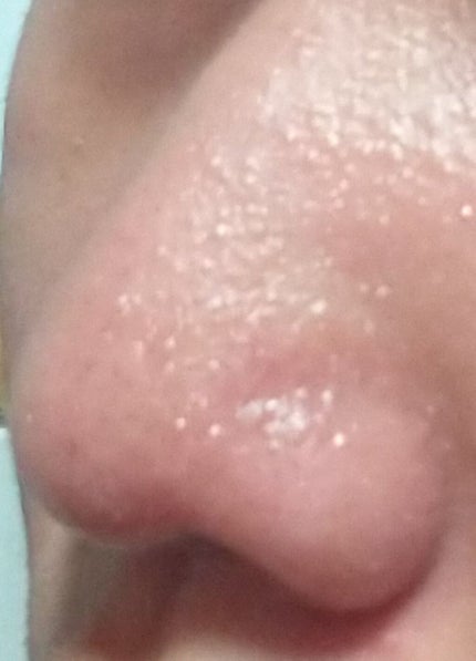 あ。 on LIPS 「このニキビって白ニキビですか、、、??光とか太陽に当たるとめっ..」(3枚目)