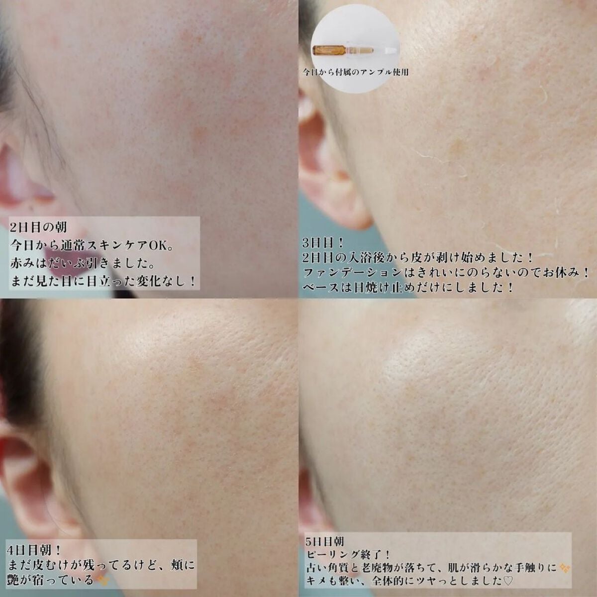 ダーマスキンピーリング|BQCELLの口コミ - BQCELL DERMA SKIN ダーマスキンピーリング|BQCELLの口コミ - BQCELL DERMA SKIN