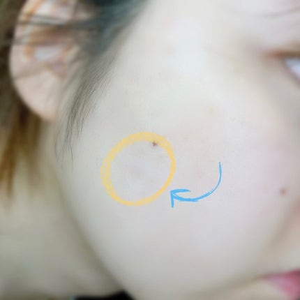 キャッチミーパッチ/CATCH ME PATCH/にきびパッチを使ったクチコミ(7枚目)