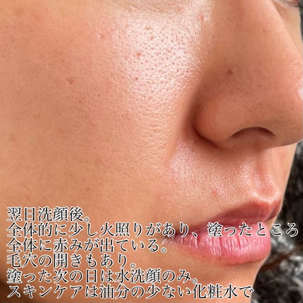 ダーマスキンピーリング/BQCELL/その他キットセットを使ったクチコミ(5枚目)