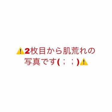 こんにちは。お久しぶりです。

4月5日に初めてニキビの投稿をし、
たくさんの方からのコメントやいいね
とっても励みになりました...嬉しかったです！😭
ありがとうございます(；；)

ニキビの経過です