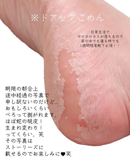 イージーパックSPT 30分タイプ/ベビーフット/レッグ・フットケアを使ったクチコミ(5枚目)