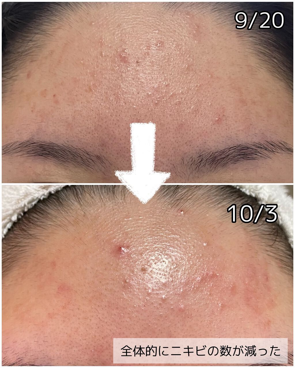 ニキビ治療薬(医薬品)/メンソレータム アクネス/その他を使ったクチコミ(2枚目)