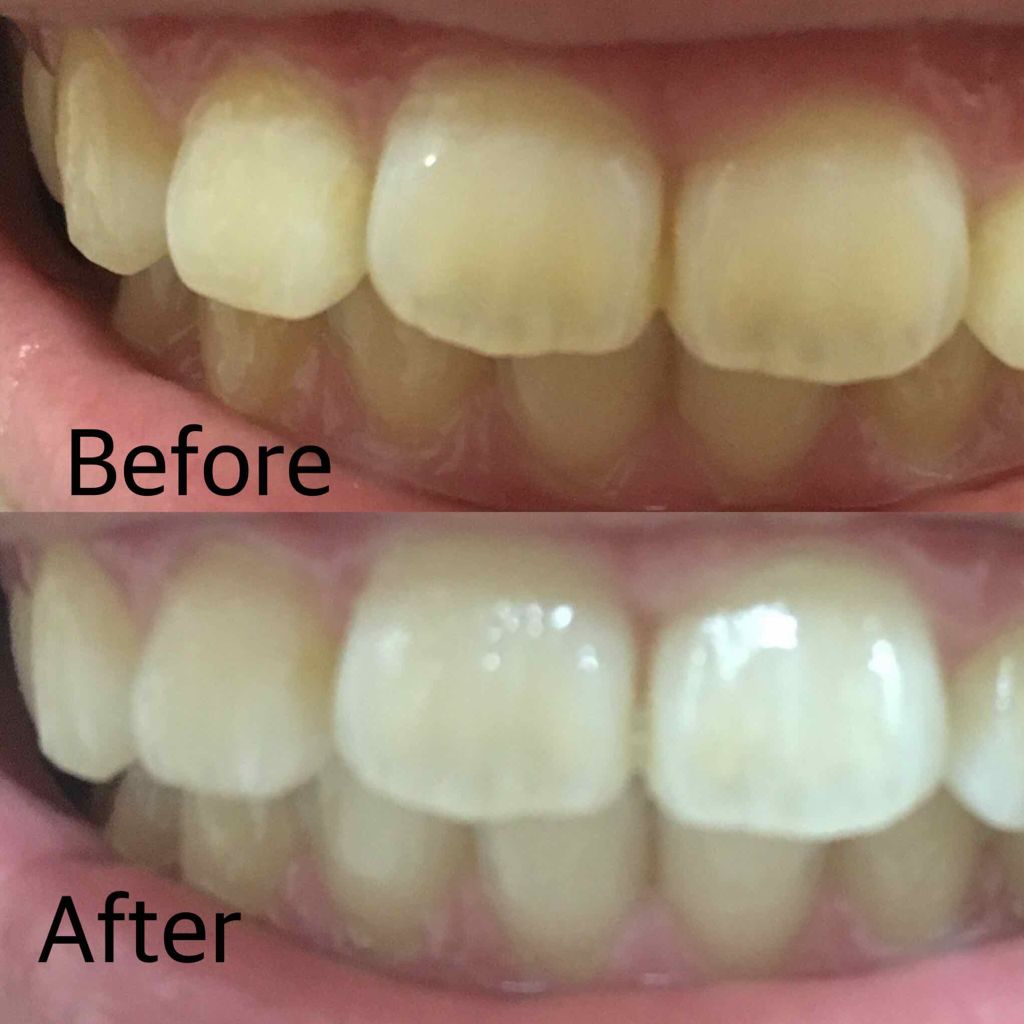 アパガードプレミオ/アパガード/歯磨き粉を使ったクチコミ(2枚目)