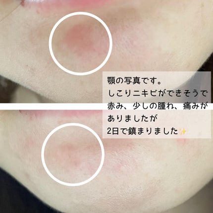 ミラクルアクネクリアスポットトリートメント/SOME BY MI/美容液を使ったクチコミ(7枚目)