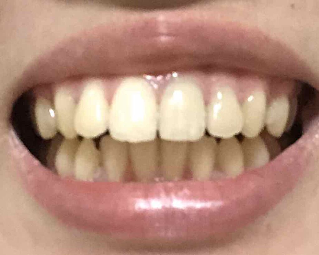 クレスト3Dホワイトニング ホワイトストリップ プロフェッショナル エフェクツ/クレスト/その他オーラルケアを使ったクチコミ（3枚目）