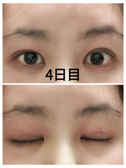 kaira on LIPS 「二重整形しちゃいました🤭今までも何度か二重の投稿をさせてもらっ..」(5枚目)