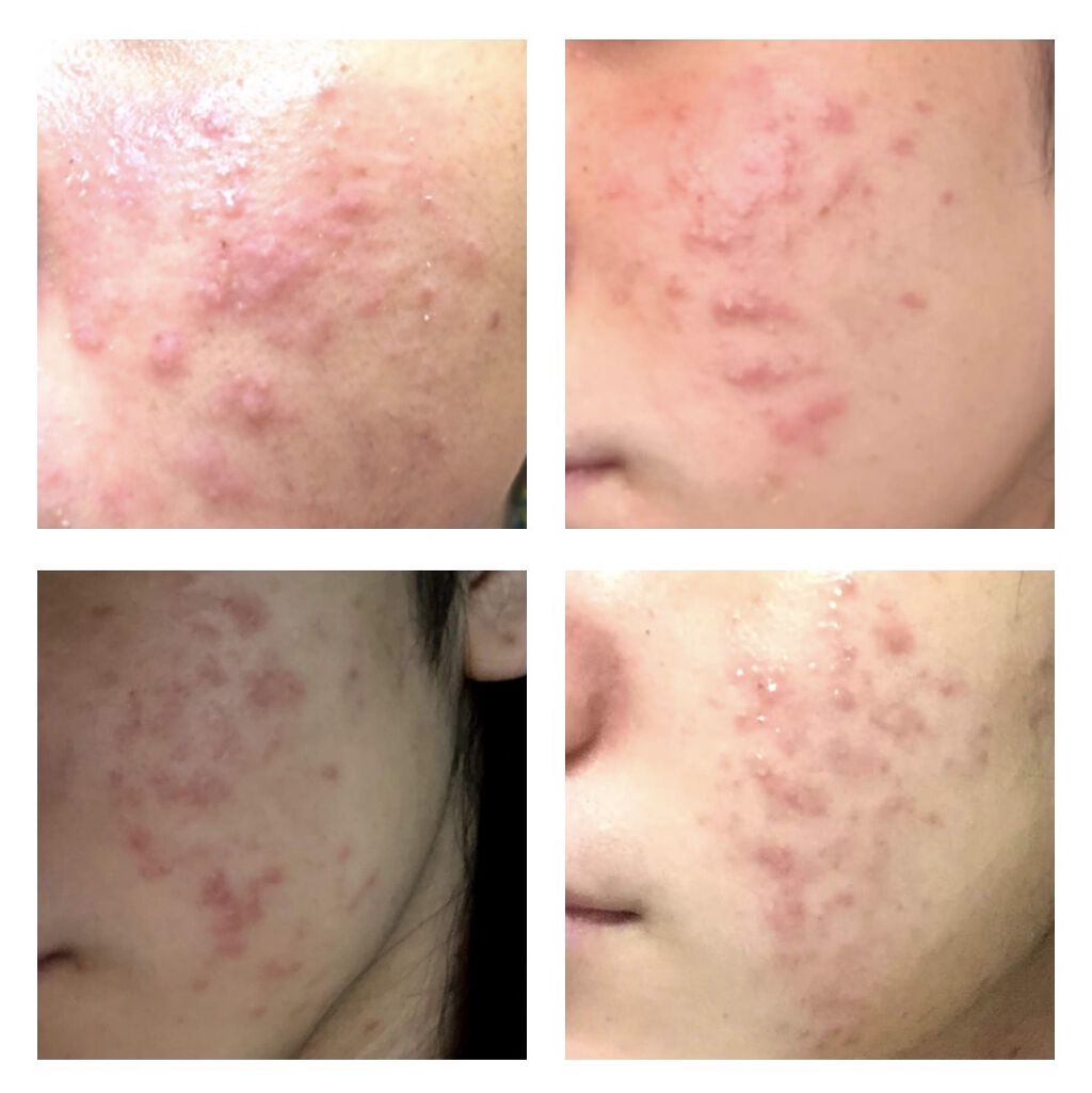 バイオイル/バイオイル/フェイスオイルを使ったクチコミ（3枚目）