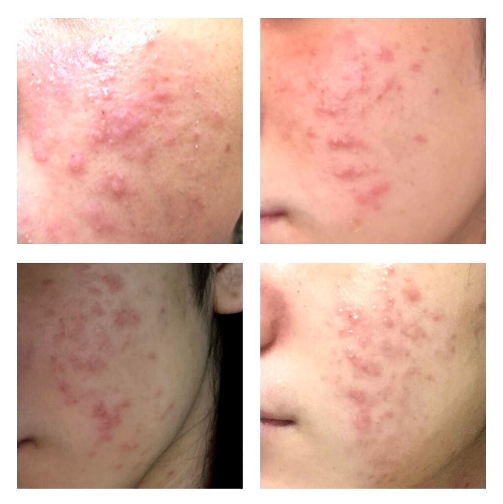 バイオイル/バイオイル/フェイスオイルを使ったクチコミ(3枚目)