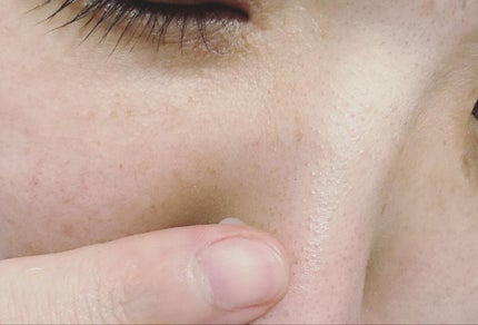 チョコブラ スペシャル毛穴ケアセット/Chocobra/スキンケアキットを使ったクチコミ(7枚目)