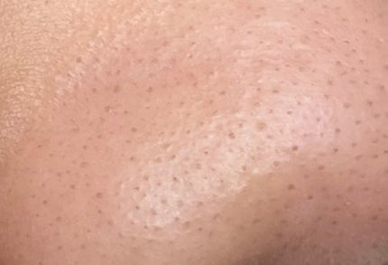 あ on LIPS 「助けてください😢私顔の毛穴が目立つのが悩みで、特に鼻の黒ずみと..」(2枚目)