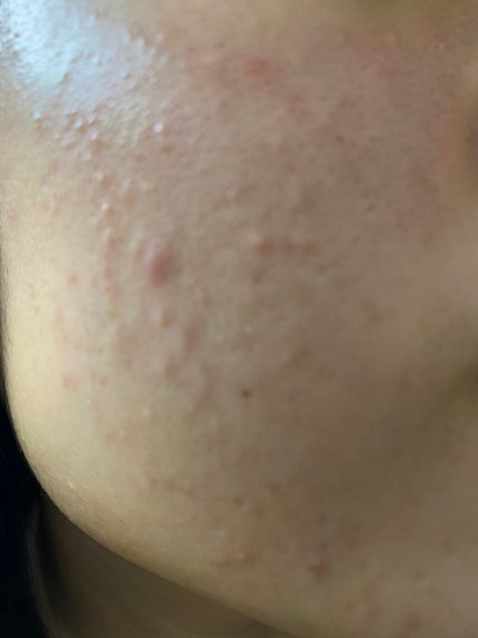 ハトムギ保湿ジェル(ナチュリエ スキンコンディショニングジェル)/ナチュリエ/美容液を使ったクチコミ(4枚目)