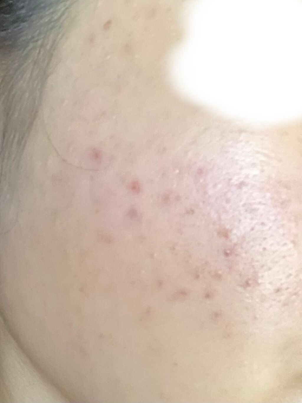 K on LIPS 「12/23~2/1までの経過12/23~1/10べピオゲル1/..」(6枚目)