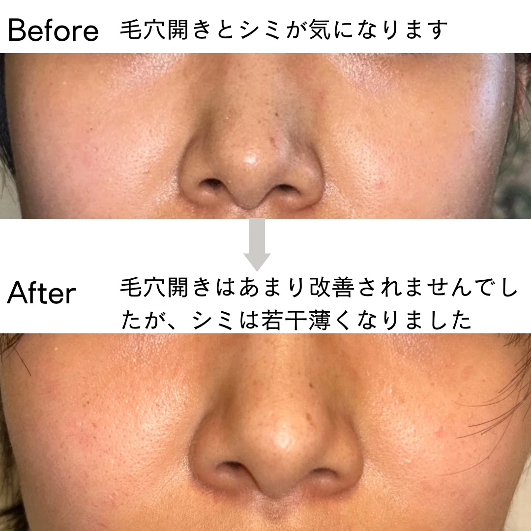 薬用 しみ 集中対策 美容液/メラノCC/美容液を使ったクチコミ（3枚目）