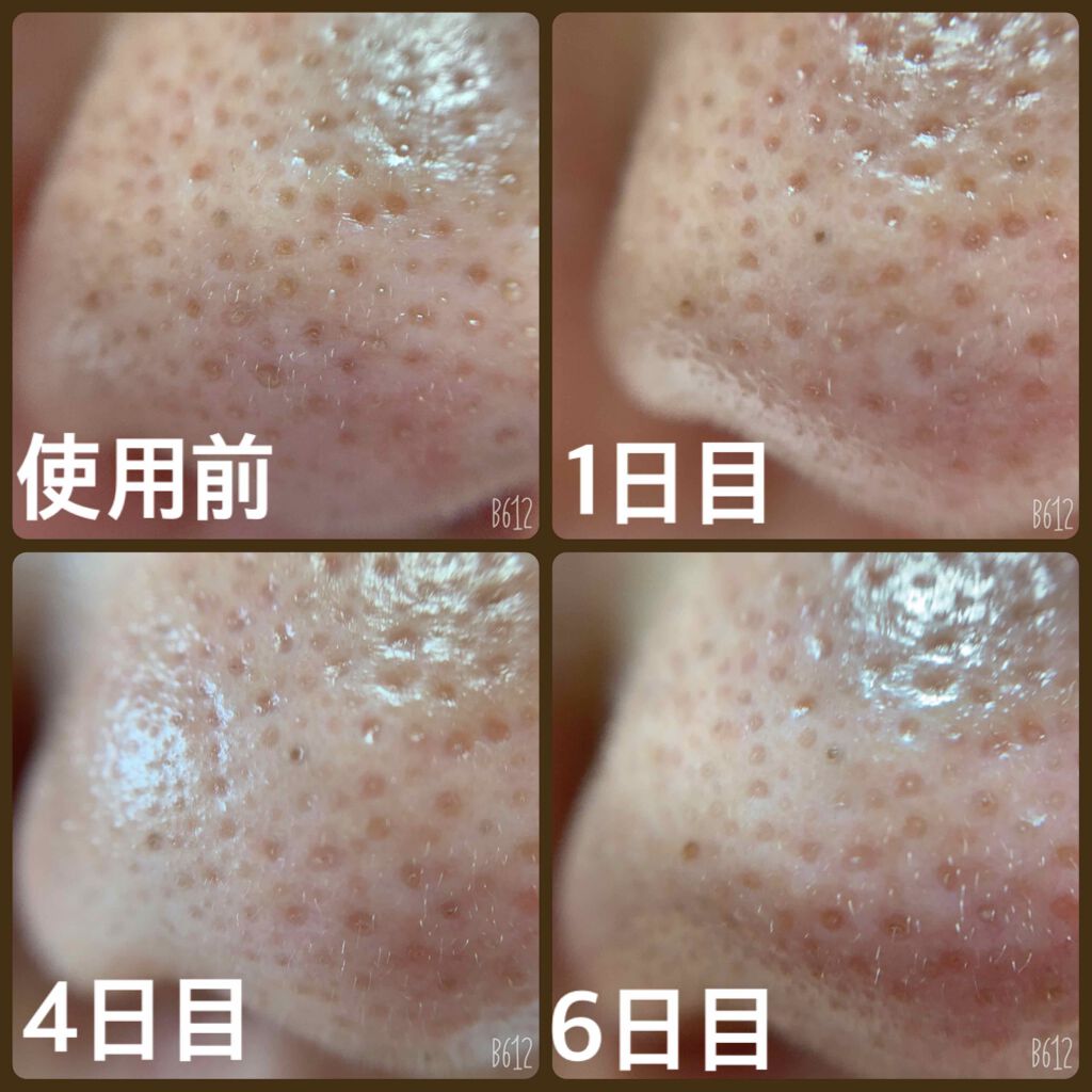 VCスーパー毛穴セラム/ラボラボ/美容液を使ったクチコミ(4枚目)