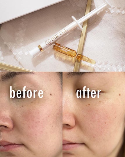 ダーマスキンピーリング/BQCELL/その他キットセットを使ったクチコミ(1枚目)