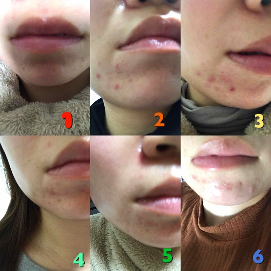 1ステップ ニキビコントロール マキシマム/STRIDEX/ピーリングを使ったクチコミ（2枚目）