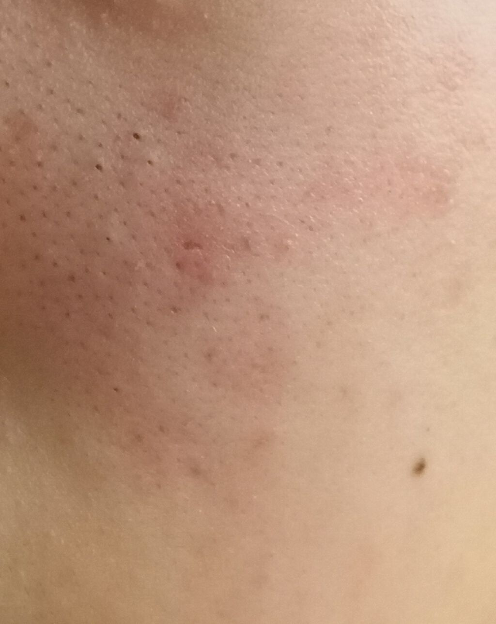 薬用 しみ 集中対策 美容液/メラノCC/美容液を使ったクチコミ（3枚目）