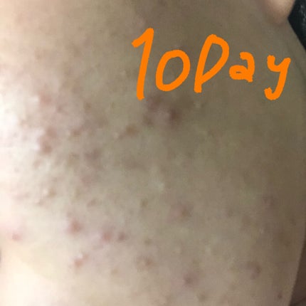 ロゼット洗顔パスタ アクネクリア/ロゼット/洗顔フォームを使ったクチコミ(2枚目)