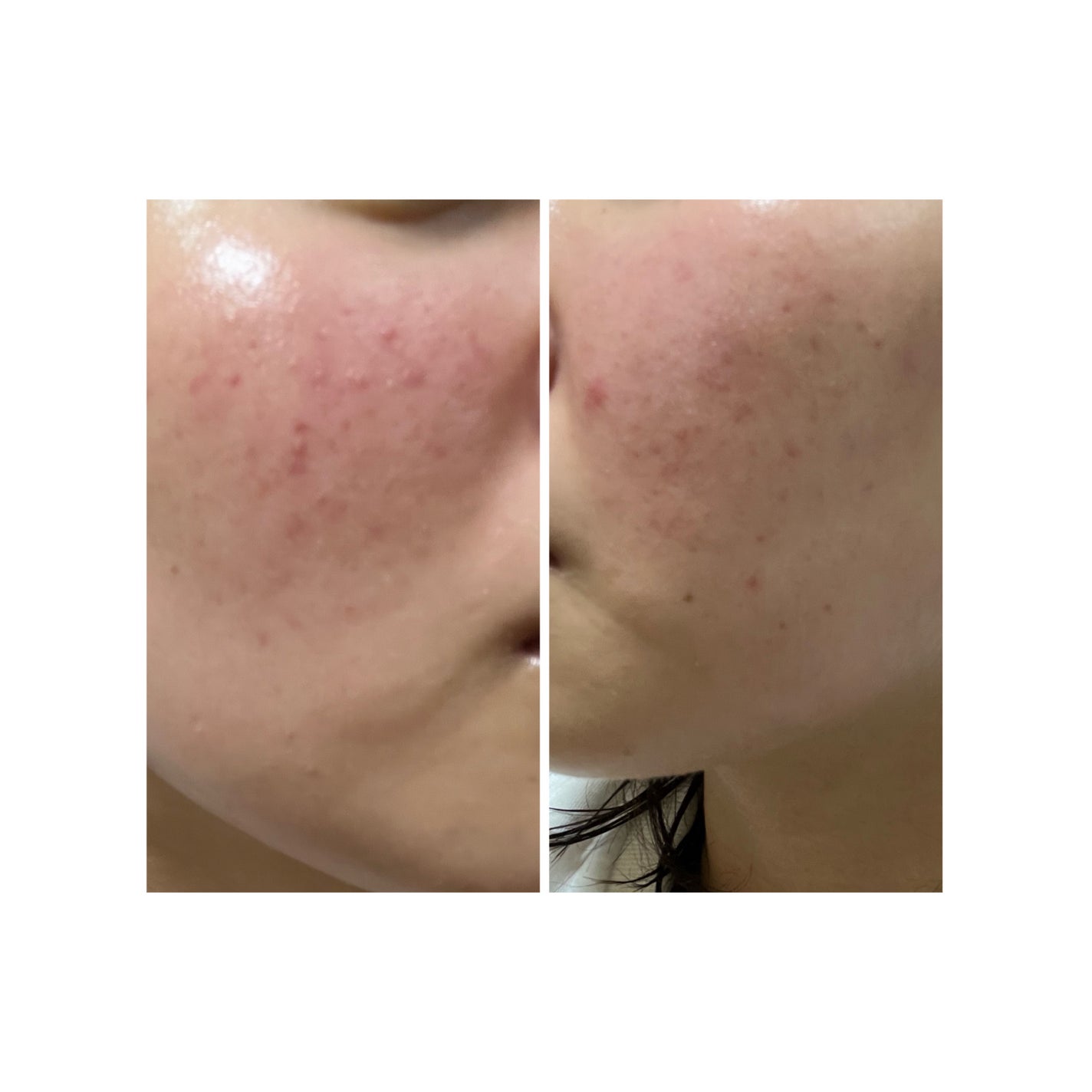 ぽむ on LIPS 「2023.9.13皮膚科に受診 エピデュオとヘパリン処方1枚目..」(4枚目)