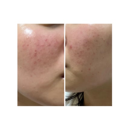 ぽむ on LIPS 「2023.9.13皮膚科に受診 エピデュオとヘパリン処方1枚目..」(4枚目)