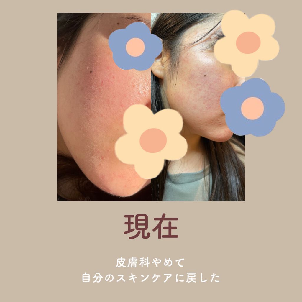 100日後に垢抜けたい女 on LIPS 「【皮膚科やめた話】こんにちは。「100日後に垢抜けたい女」です..」(5枚目)
