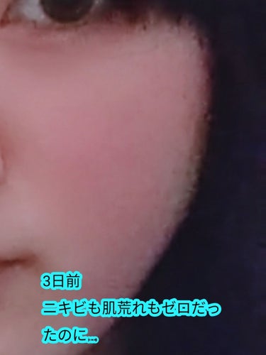 34番 on LIPS 「⚠️汚肌注意朝起きたら肌に赤いブツブツが一気に17個できてまし..」（2枚目）