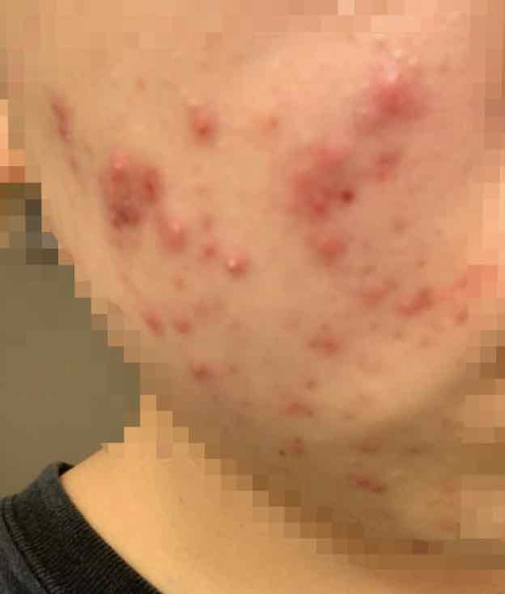 A アクネフォーム/NOV/洗顔フォームを使ったクチコミ（2枚目）