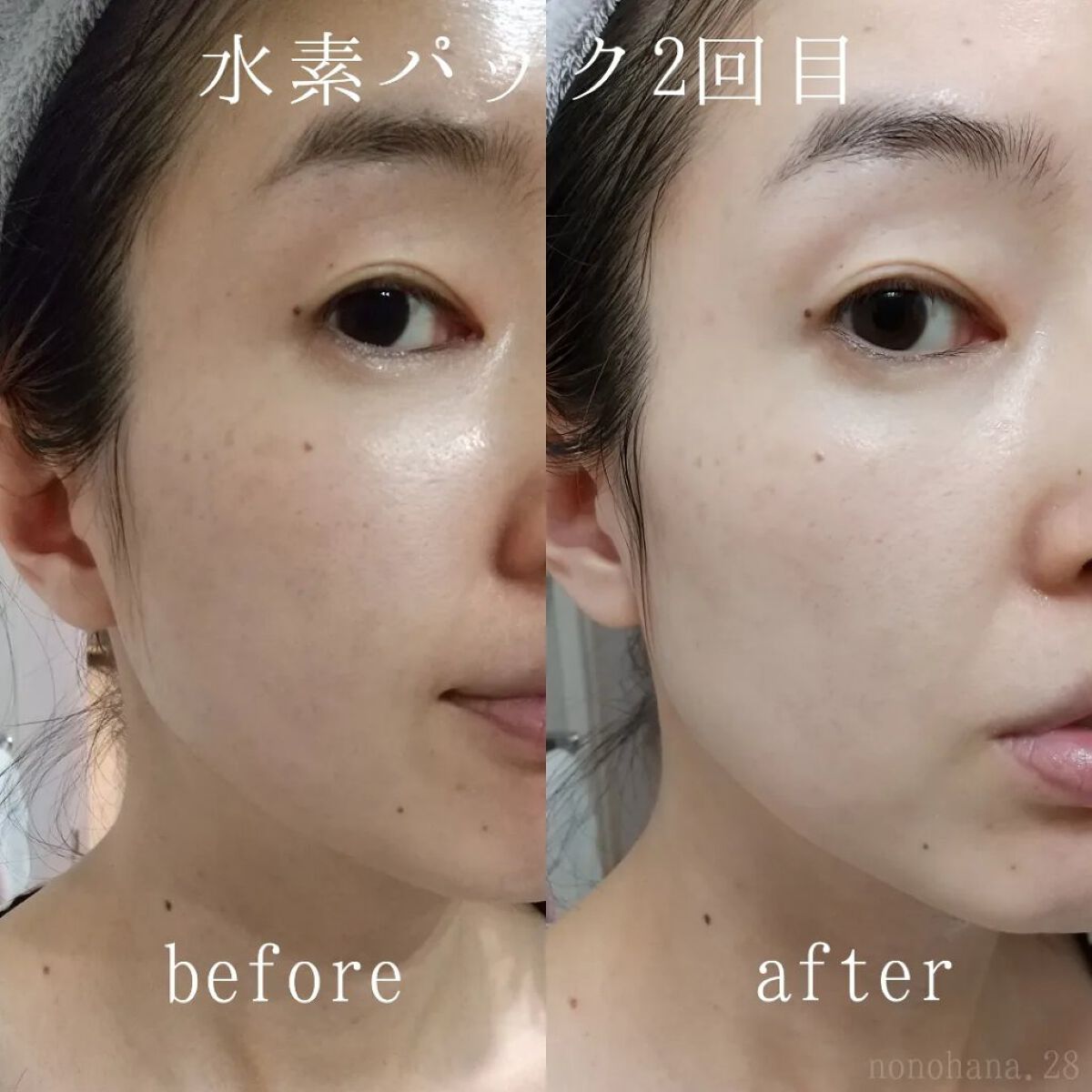 水素パック｜SKINLEAPの効果に関する口コミ - 【速攻トーンアップに