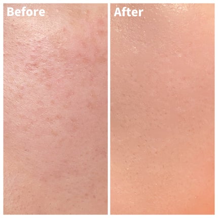 ピンクティーツリーカバークッション/APLIN/クッションファンデーションを使ったクチコミ(6枚目)