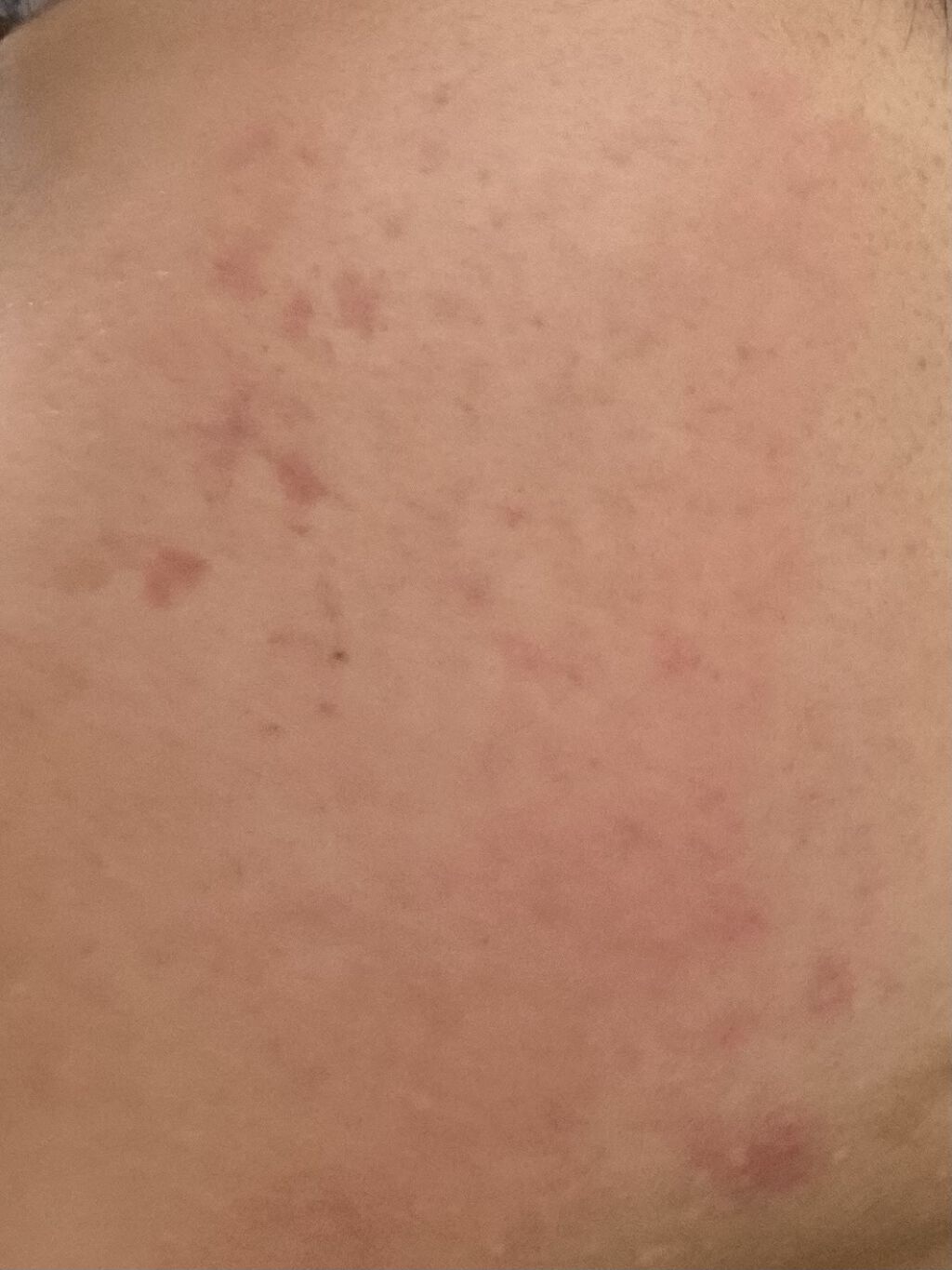 エピデュオゲル/マルホ株式会社/その他を使ったクチコミ（2枚目）